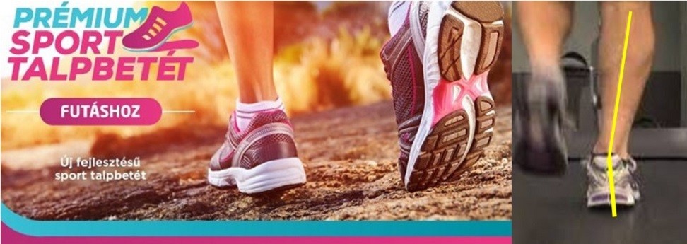 Dinamikus lábvizsgálat: járás/futás elemzés